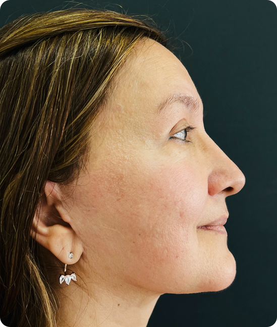 Rejuvenecimiento facial con elevación del tercio medio y cervicoplastia