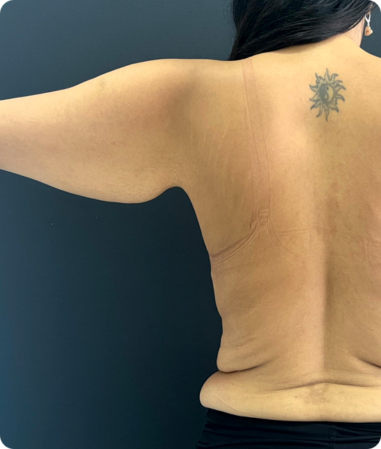 Antes - Braquioplastia