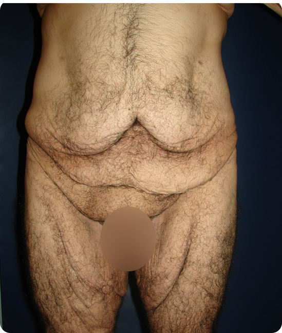 Antes - Cruroplastia