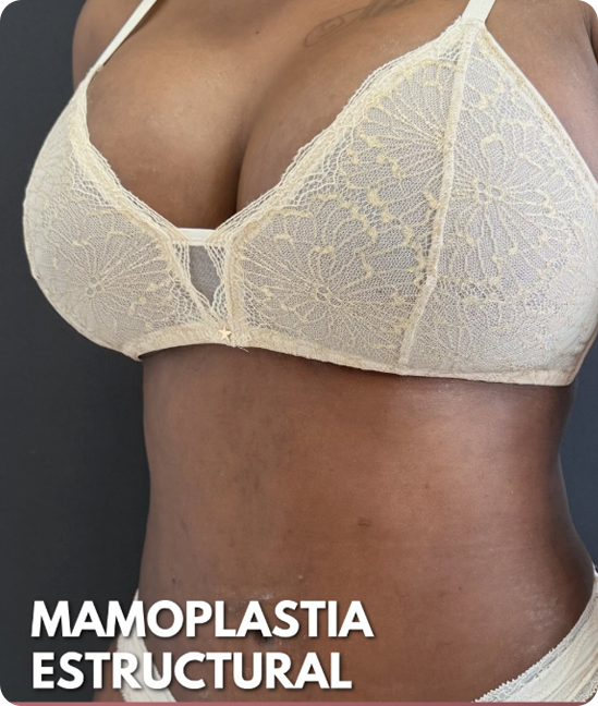 Resultado Mamoplastia de Reducción