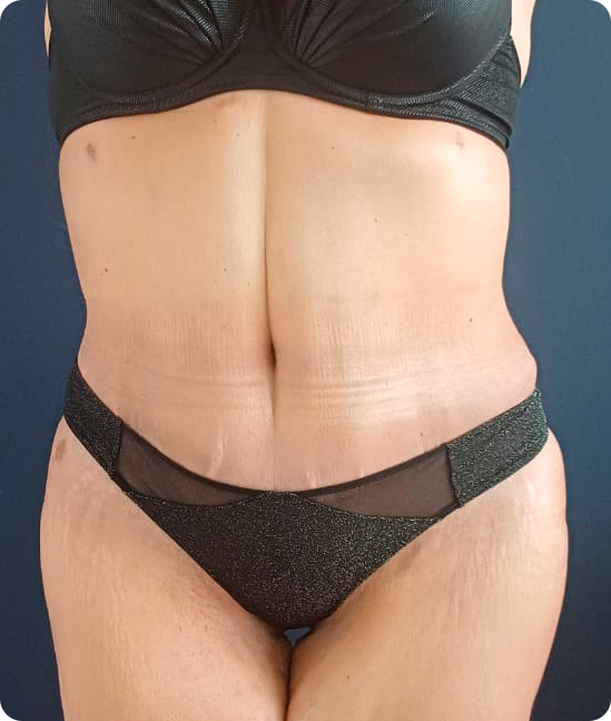 Abdominoplastia Circunferencial tras Pérdida Masiva de Peso