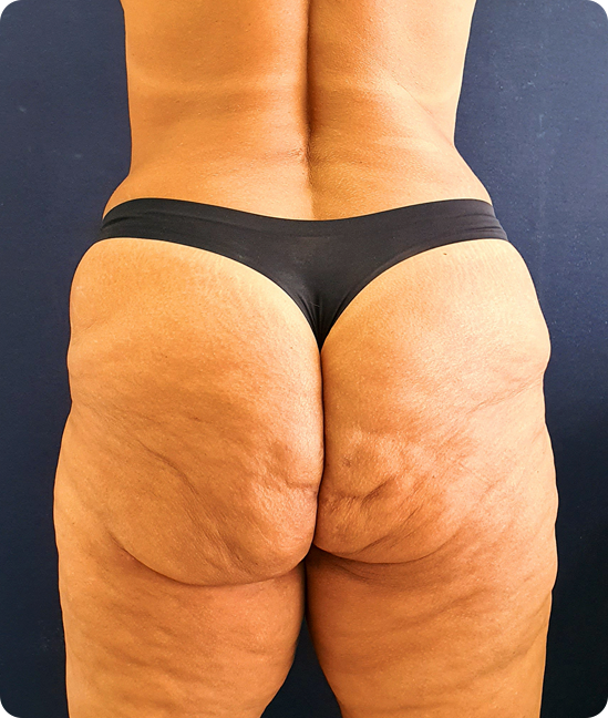 Antes - Reconstrucción Glútea posterior a Resección de Biopolímeros