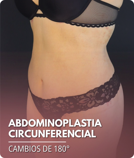 Resultado Reconstrucción Glútea posterior a Resección de Biopolímeros