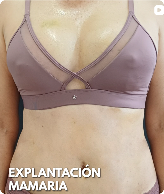 Resultado Retiro de Prótesis Mamarias (Explantación)
