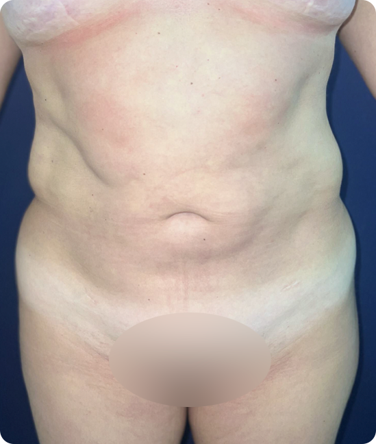 Antes - Abdominoplastia reversa