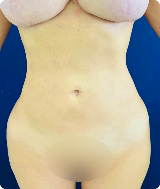 Abdominoplastia reversa