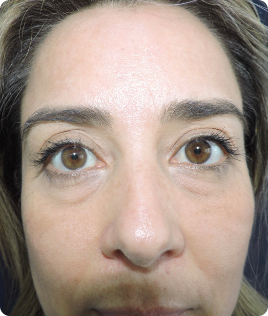 Antes - Blefaroplastia