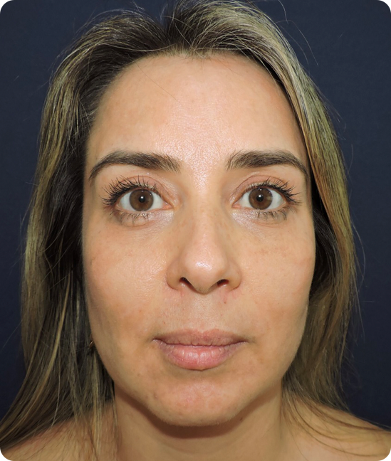 Blefaroplastia