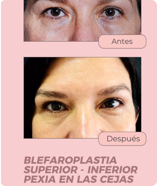 Resultado Blefaroplastia