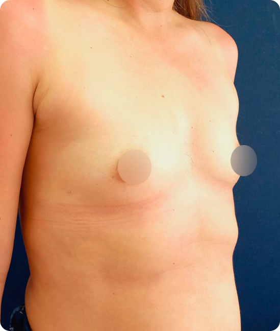 Antes - Mamoplastia de Aumento