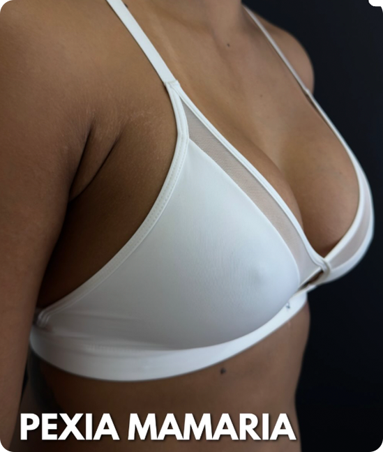 Resultado Mastopexia con Implantes