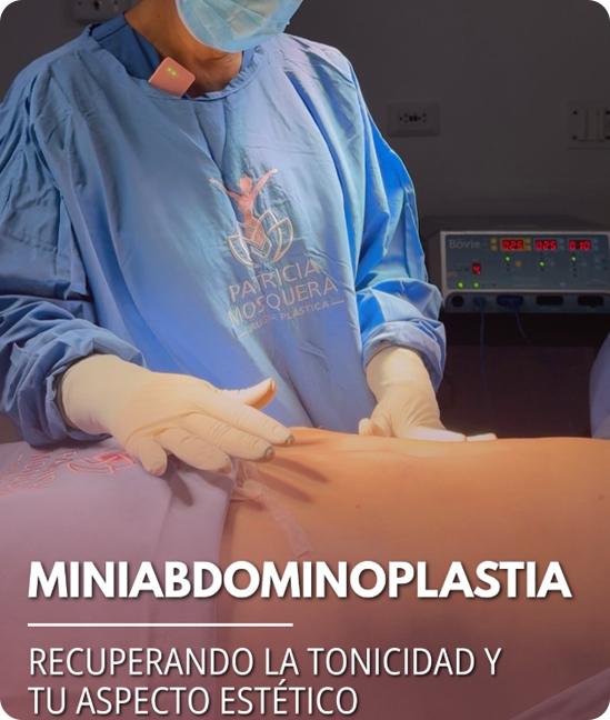 Resultado Miniabdominoplastia