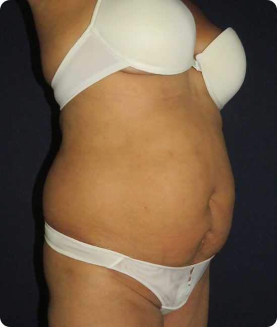 Antes - Reconstrucción de la Pared Abdominal