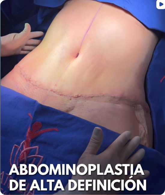 Resultado Reconstrucción de la Pared Abdominal
