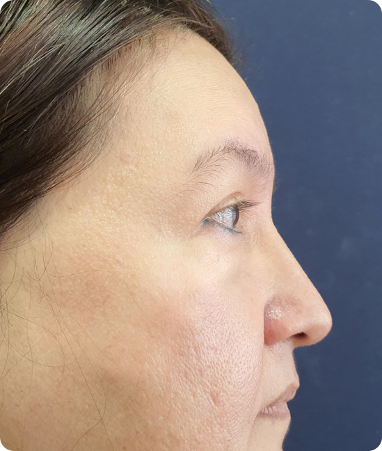 Antes - Rejuvenecimiento facial con elevación del tercio medio y cervicoplastia