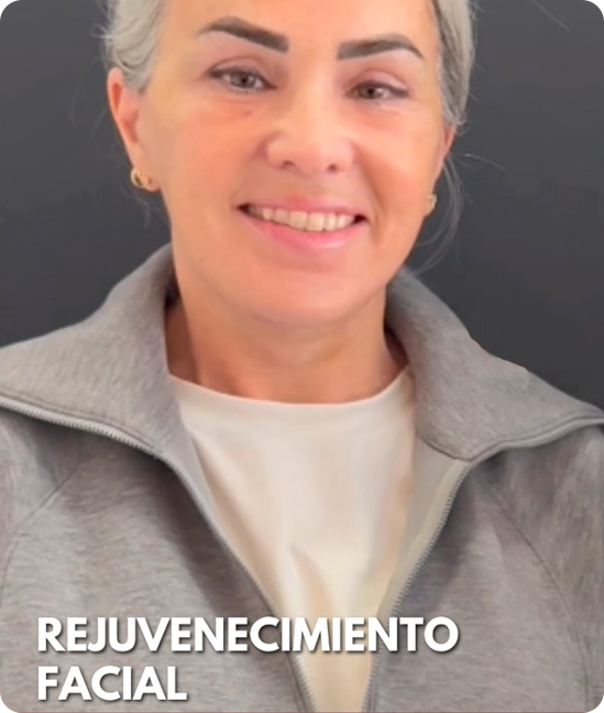 Resultado Rejuvenecimiento facial con elevación del tercio medio y cervicoplastia